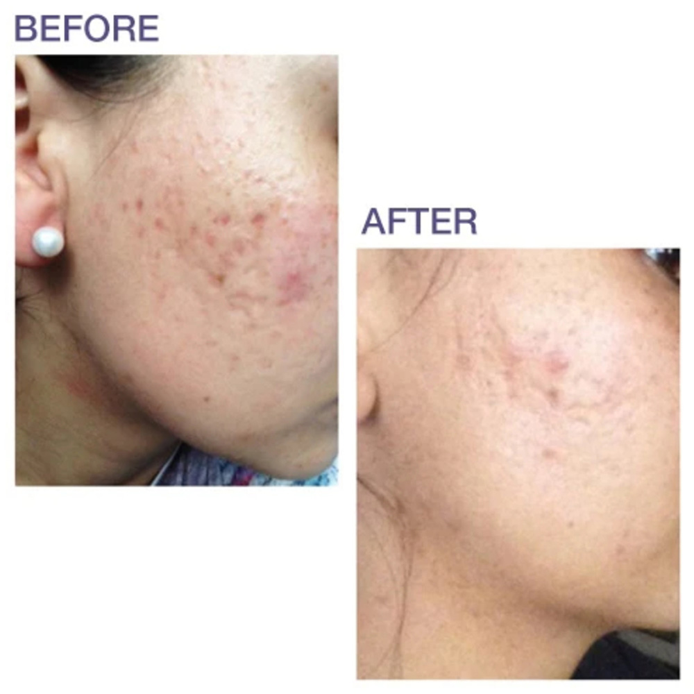 Bioderms - Pro-Sil Silicone Stick For Scar Original 4.25g