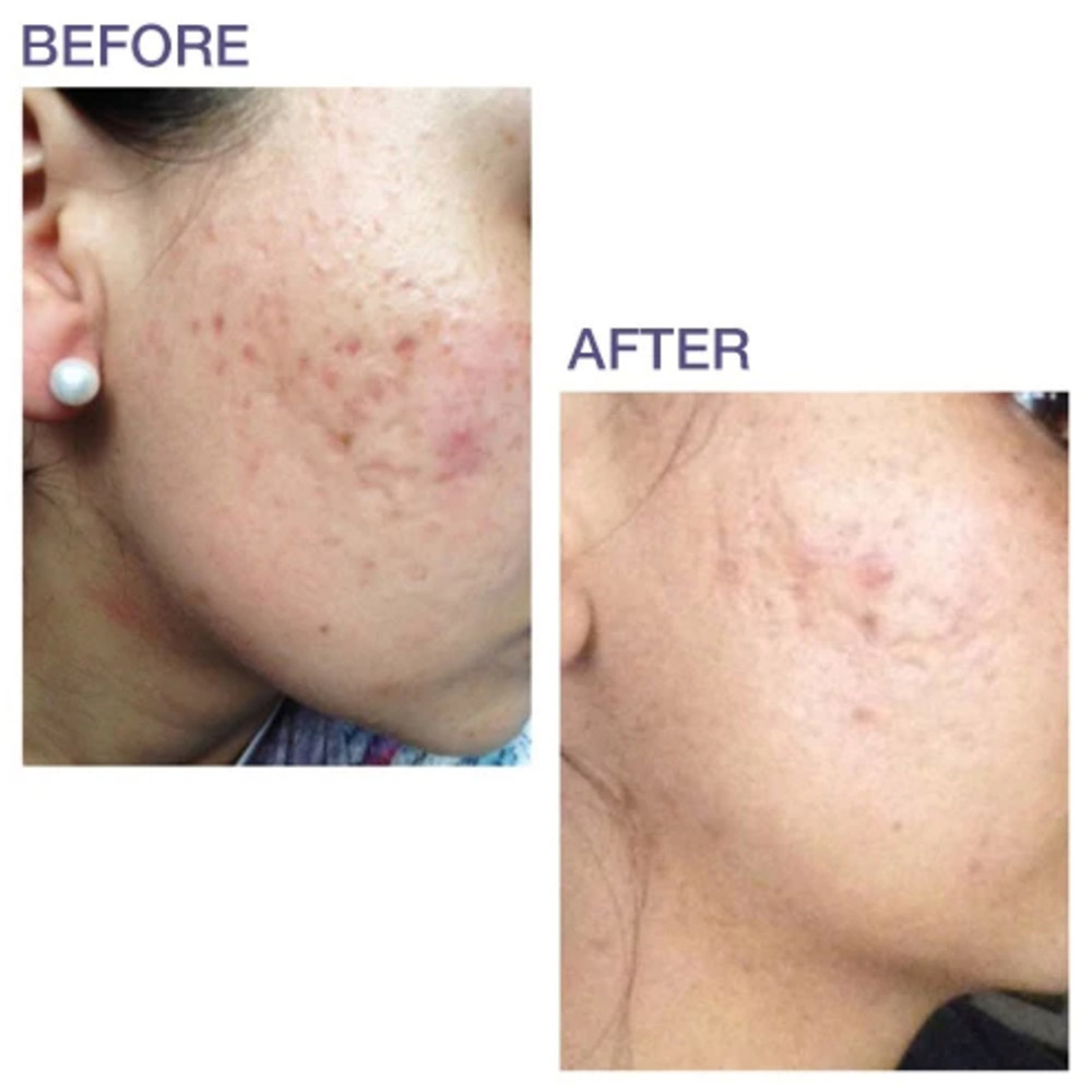 Bioderms - Pro-Sil Silicone Stick For Scar SPF-15 4.25g
